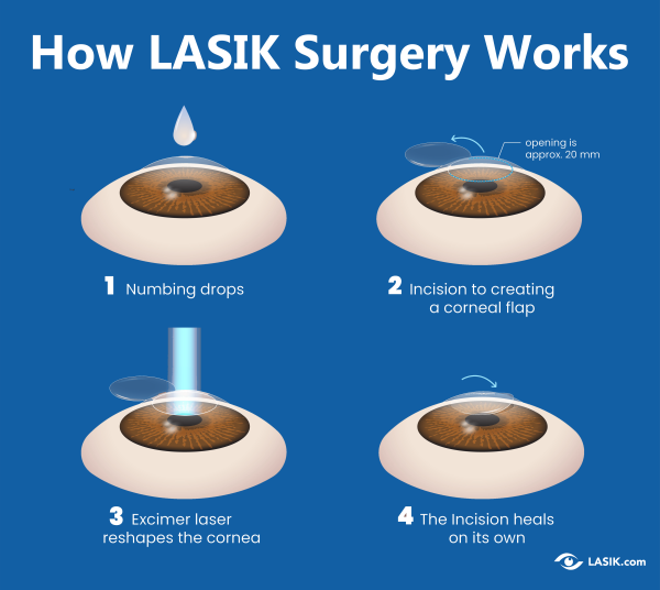 How Does LASIK Eye Surgery Work? | LASIK.com™ Official Site