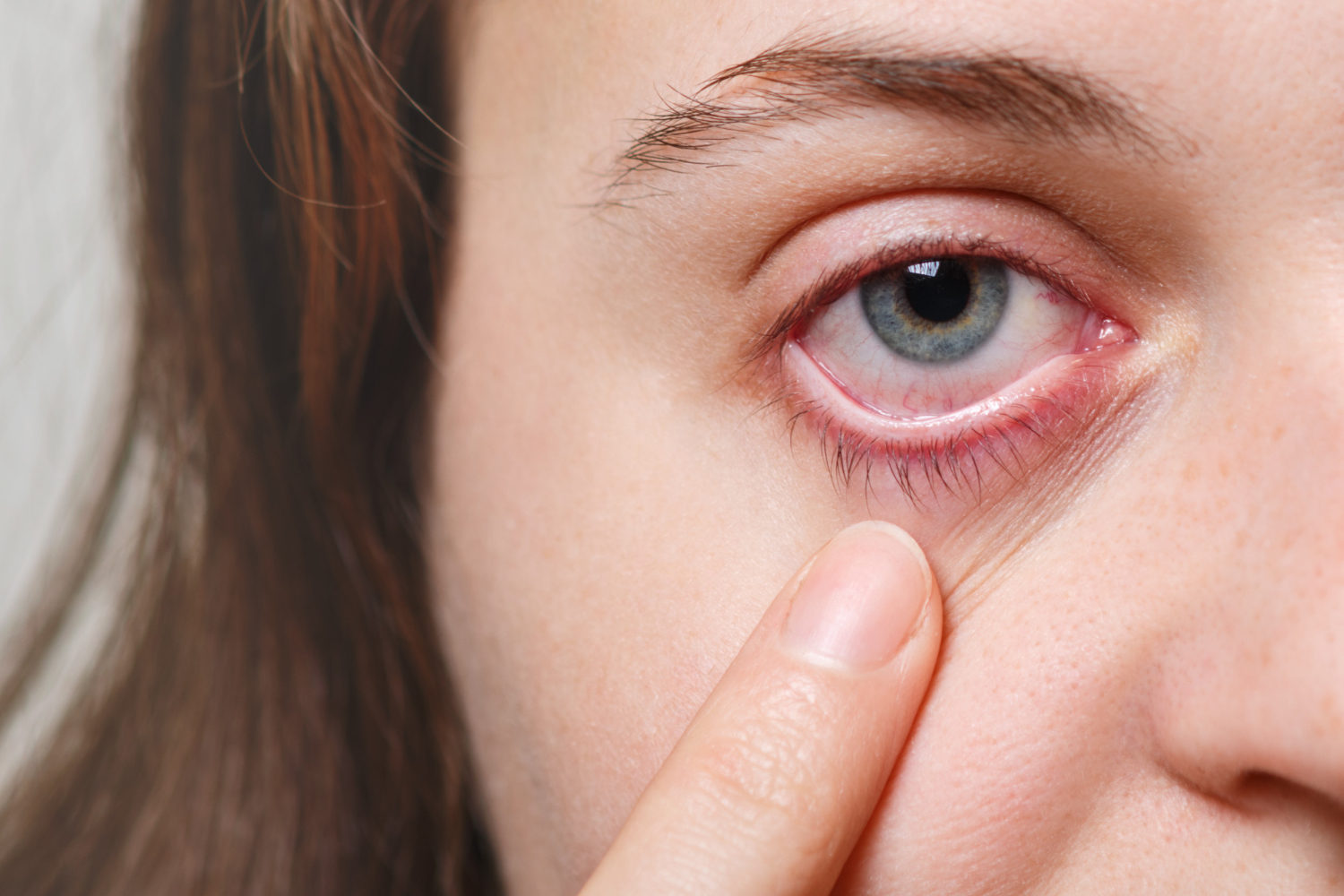 eye infection from contact lenses